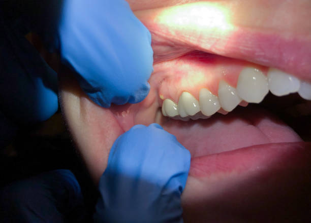 Best Broken Tooth Emergency  in Richgrove, CA